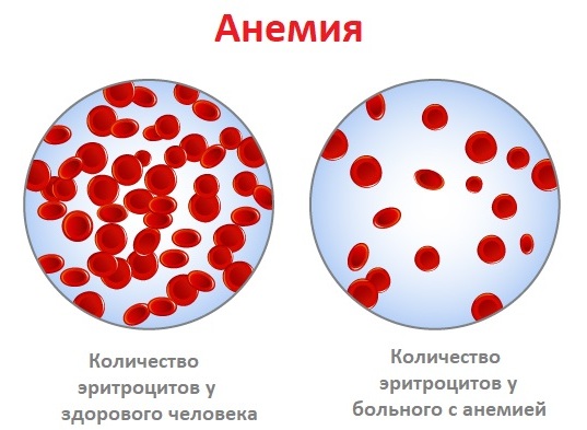 Анемия