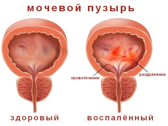 Цистит