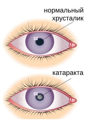 Катаракта