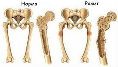 Рахит