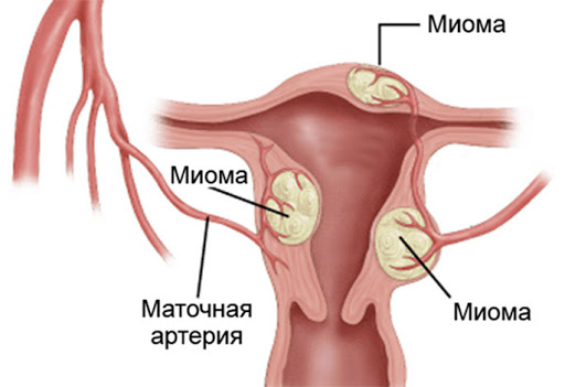 миома матки