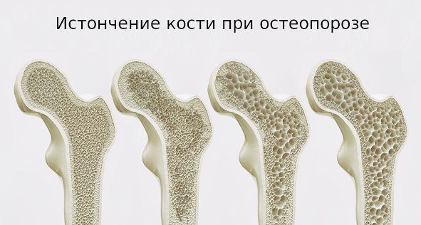 Остеопороз - причина хрупкости костей.