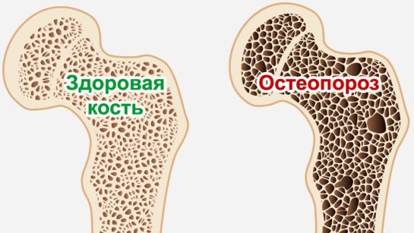 Остеопороз - вопросы и ответы