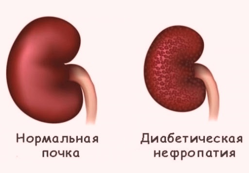 Диабетическая нефропатия