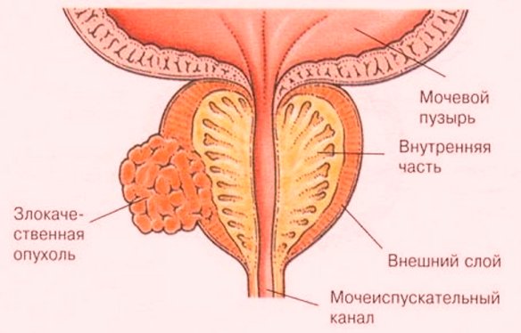Рак простаты