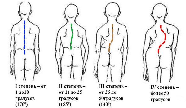 Степени сколиоза.
