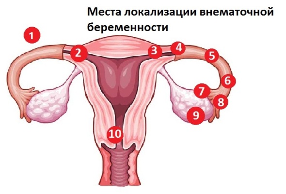 Внематочная беременность - места локализации