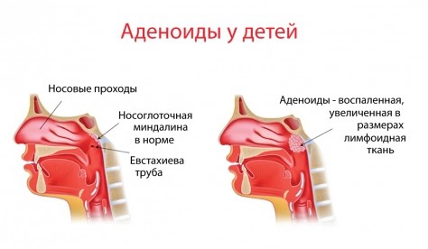 Фото аденоидов - норма и патология.