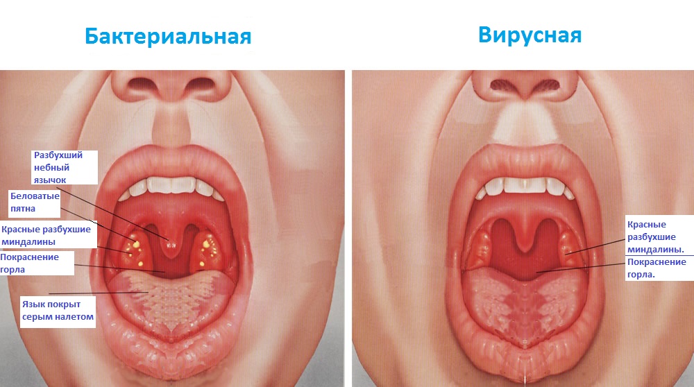 Бактериальная и вирусная ангина - фото. Разновидности ангины.