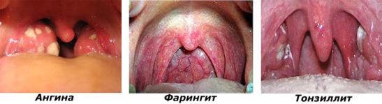 Тонзиллит, ангина.