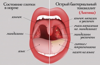 ангина