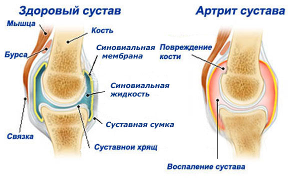 Здоровый сустав и сустав, пораженный артритом