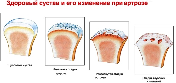 Стадии развития артроза
