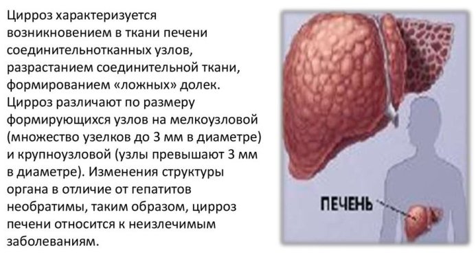 Цирроз печени