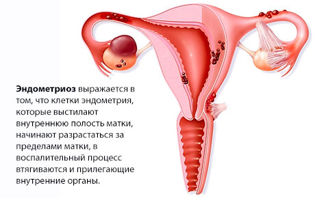Эндометриоз.