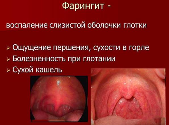 Фарингит