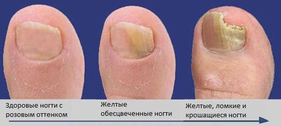 грибок ногтей на ногах