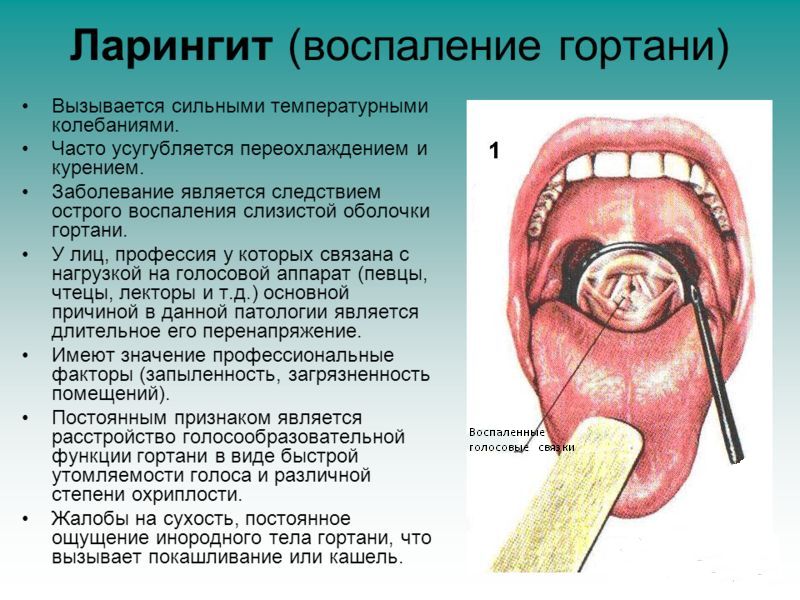 Ларингит у детей и у взрослых Ларингит - фото, симптомы.