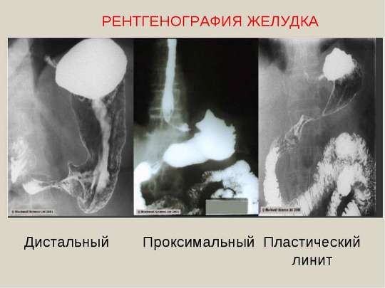 Линит. Гастроэнтерология.