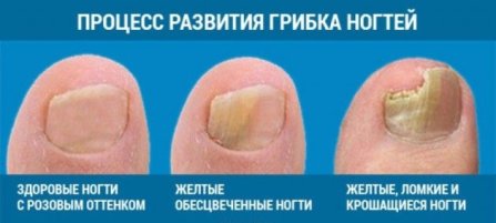 Внешние проявления грибка ногтей