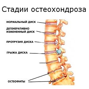 Стадии остеохондроза.