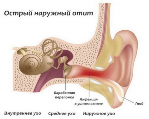 Наружный отит Наружный отит - фото