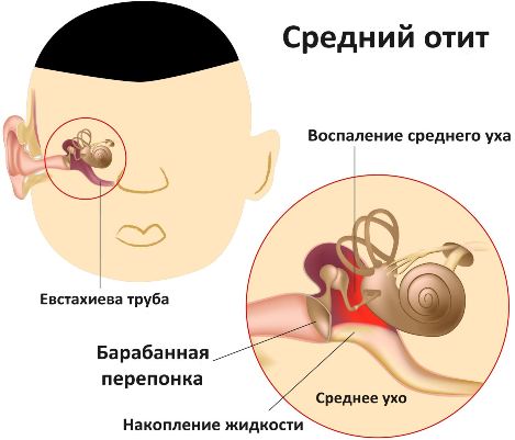 Средний отит Средний отит - фото