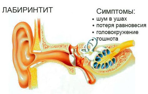 Внутренний отит Внутренний отит - фото