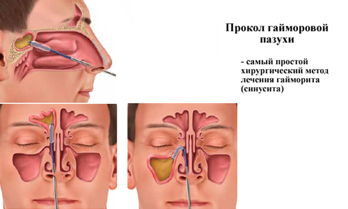 Метод Прокол Прокол гайморовой пазухи при гайморите