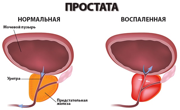 Простатит - фото. Простата - воспаление и норма.