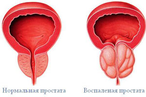 Простатит - развитие.