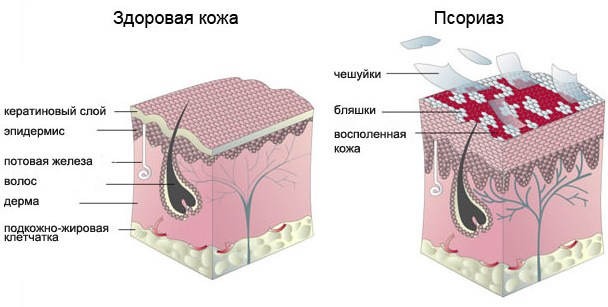 Здоровая кожа и псориаз Сравнение нормы и патологии.