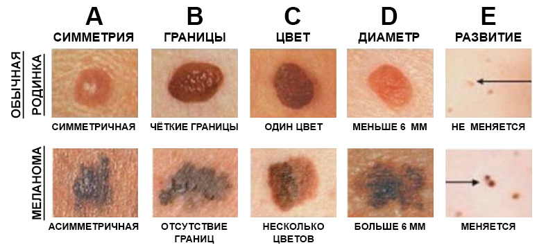 Опасные родинки
