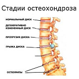 Стадии развития остеохондроза позвоночника.