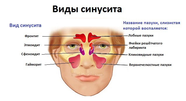 Виды синусита. Варианты локализации синусита.