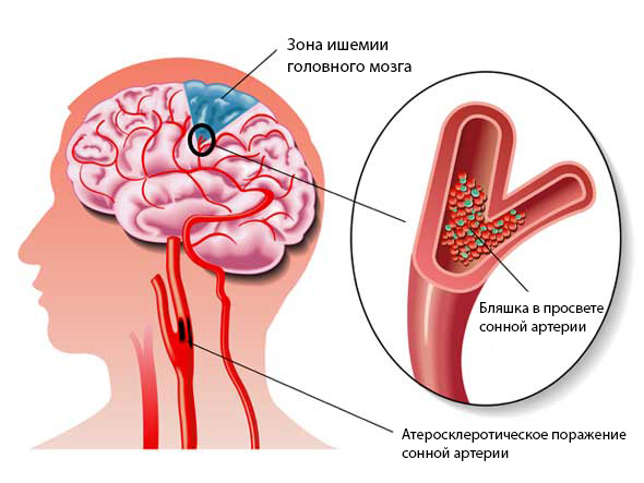 сонные артерии