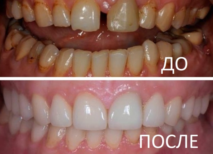 Виниры - фото